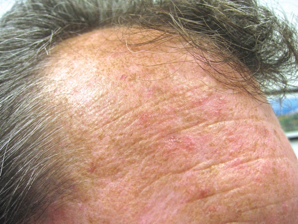 actinic keratoses