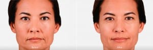 Before & After Juvederm XC Lips Treatment