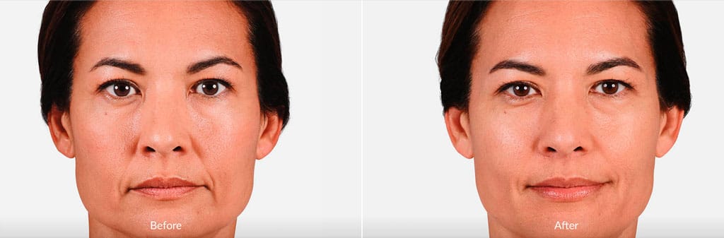 Before & After Juvederm XC Lips Treatment