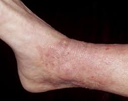 Lichen Simplex Chronicus Lichen Simplex Chronicus