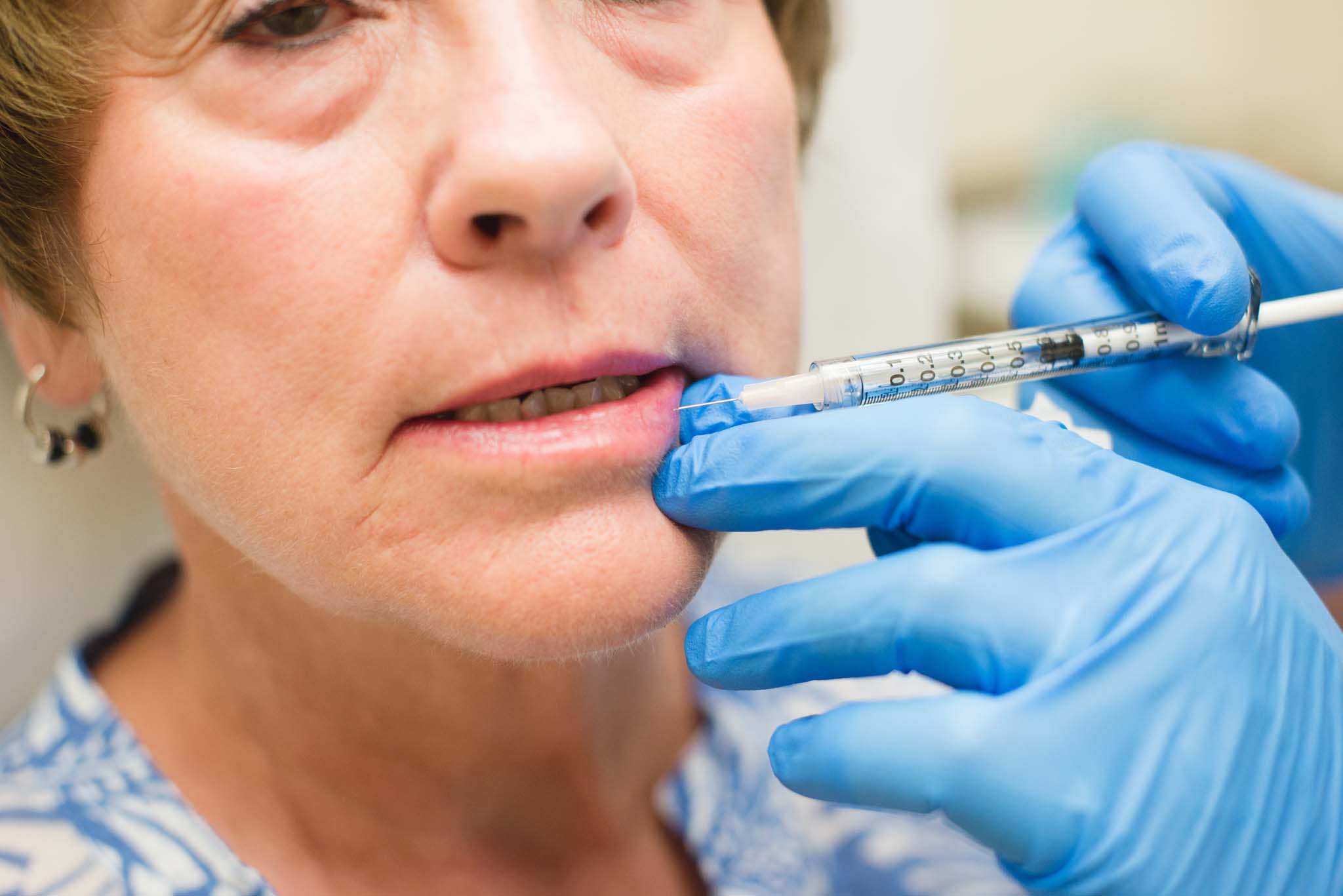 Needle injection on lips