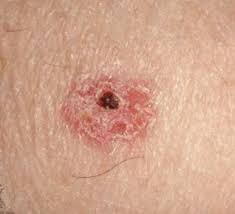 Squamous Cell Carcinoma (SCC)
