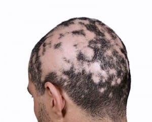 Example of alopecia areata