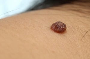 Example of Bump & Growth on Skin