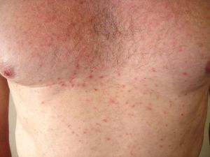 What does Grover's disease look like?