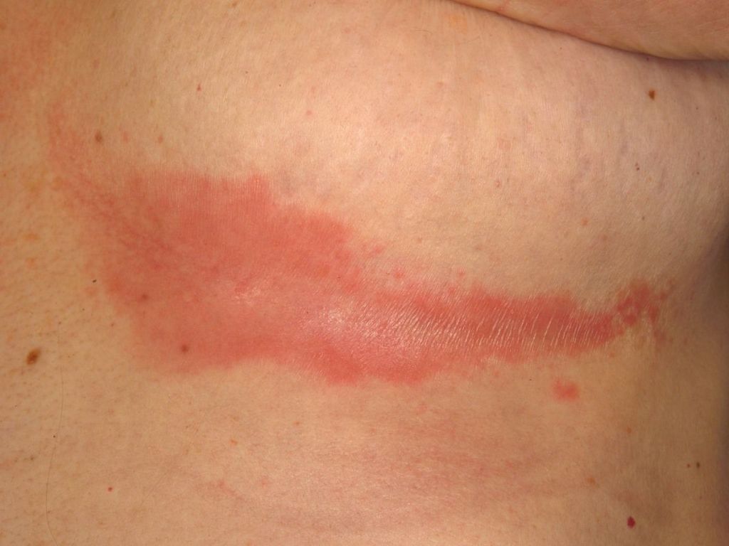 Intertrigo Intertrigo