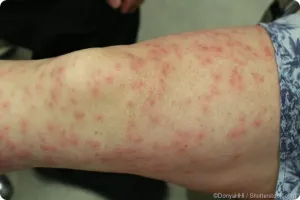 Irritant Dermatitis