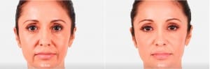 Before & After Juvederm Facial Treatment