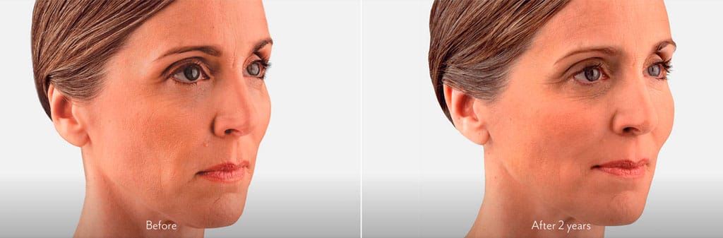 Before & After Juvederm XC Cheeks Treatment