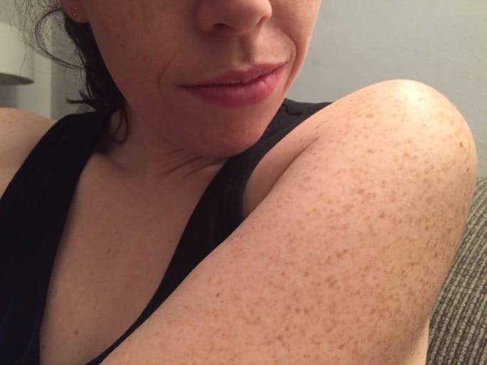 keratosis pilaris