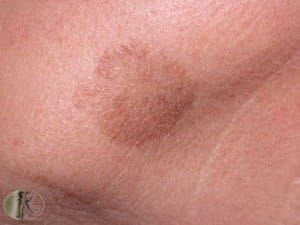 Laser Treatment Pigment Issues