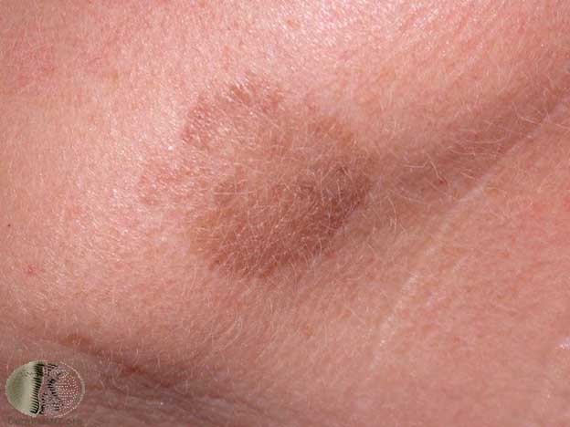 Laser Treatment Pigment Issues