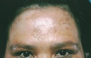 Face highlighting Melasma