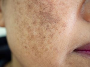 Melasma Treatment