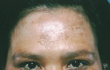 Melasma