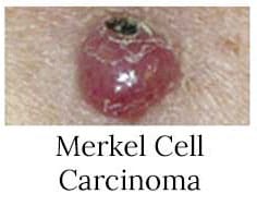 Merkel Cell Carcinoma