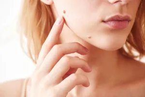 Safe Mole Removal at Palmetto Skin and Laser Center of Rock Hill, SC. Our Board Certified Dermatologists provide expert, minimally invasive procedures for clear skin.