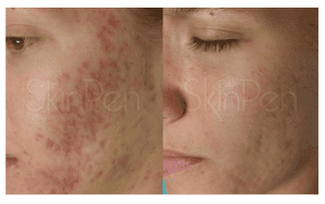Before & After Skinpen on Face