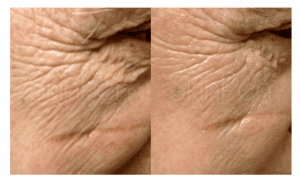 Before & After Skinpen on crowsfeet