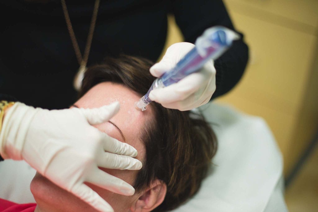 Skinpen treatment on female face