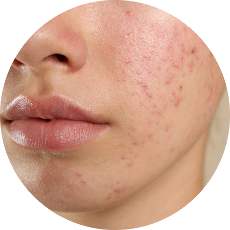 Acne Dermatologist