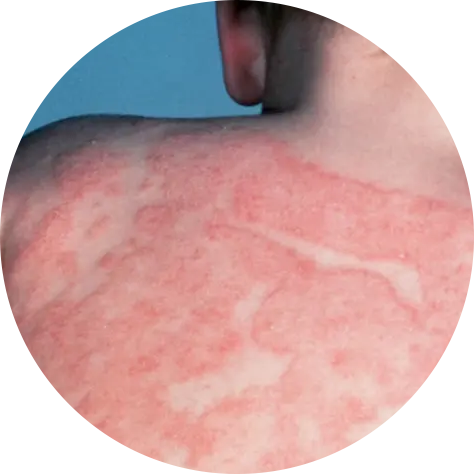Atopic Dermatitis Dermatologist