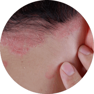 Eczema Skin Dermatologist