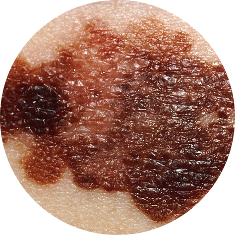 Melanoma Skin Screening