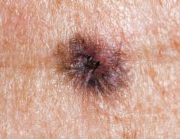 Ugly Duckling Skin Cancer