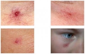 Laser Treatments for Unwanted Veins