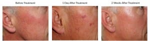 Before & After vascular laser treatment on face
