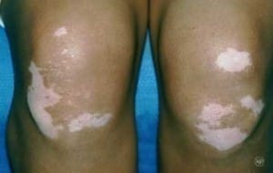 Knees with Vitiligo