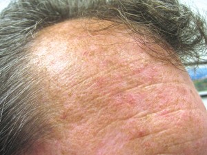 Example of Actinic Keratoses on Forehead