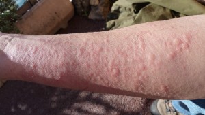 Example of Allergic Contact Dermatitis