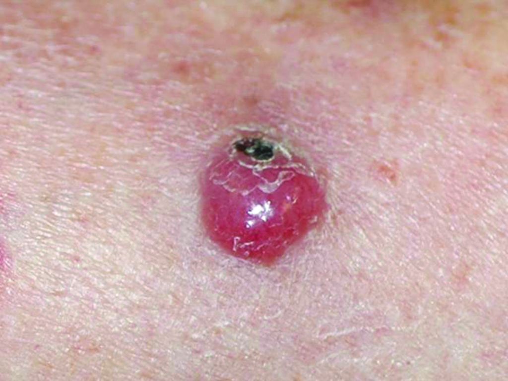 Example of Merkel Cell Carcinoma Example of Merkel Cell Carcinoma
