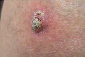 Squamous Cell Carcinoma (SCC)
