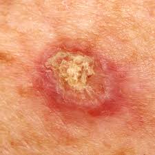 Squamous Cell Carcinoma (SCC)