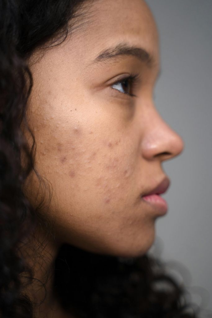 Acne dermatologist for teens and adults