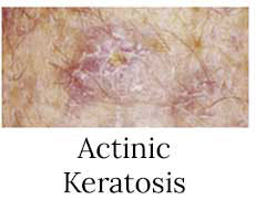 Actinic Keratosis