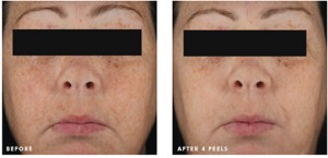 Before & After of Advanced Facial Peel