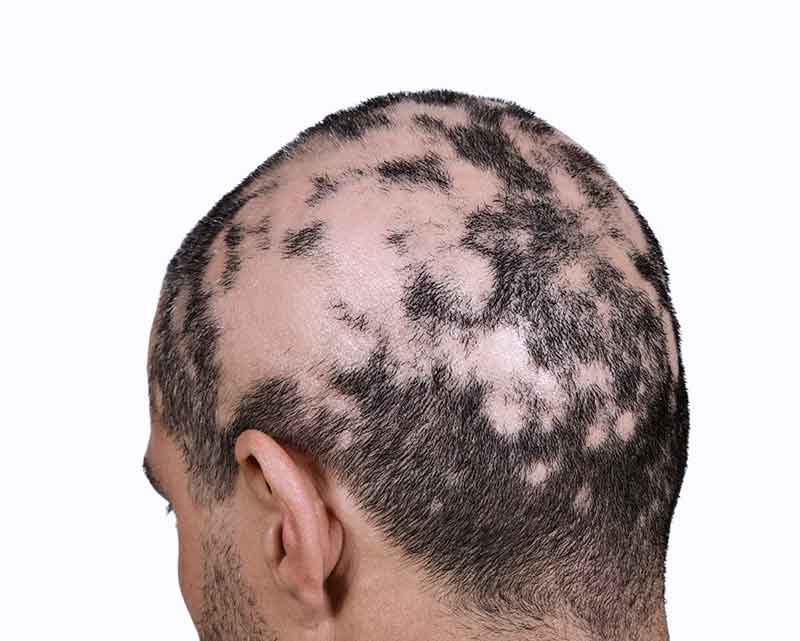 Alopecia Areata - Palmetto Skin & Laser Center Dermatologists