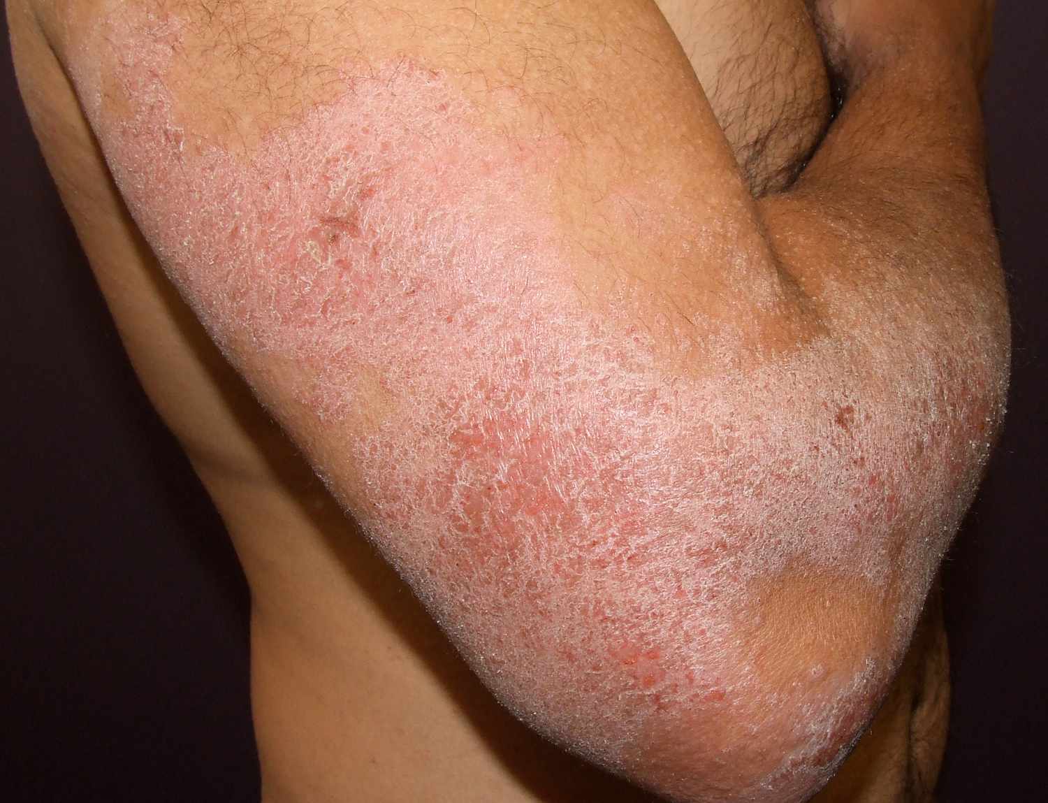Atopic dermatitis results from a defective skin barrier, immune dysregulation, and genetic factors. Atopic dermatitis results from a defective skin barrier, immune dysregulation, and genetic factors.