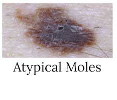 Atypical Moles