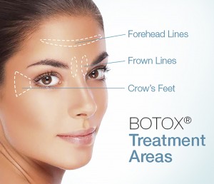 botox-areas