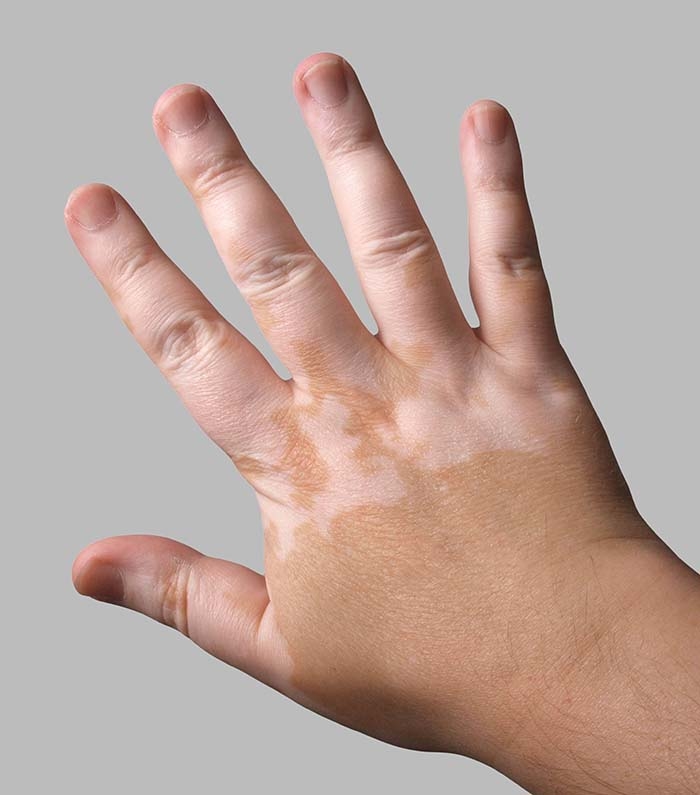 Expert guide to common skin color problems including melasma, vitiligo, tinea versicolor, and sun damage. Vitiligo