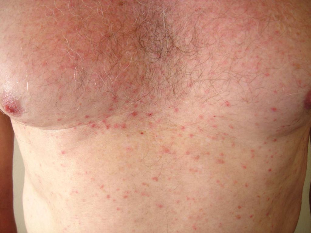 What does Grover's disease look like?