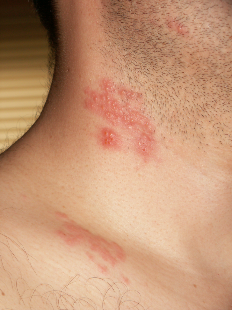 Herpes Zoster (Shingles)