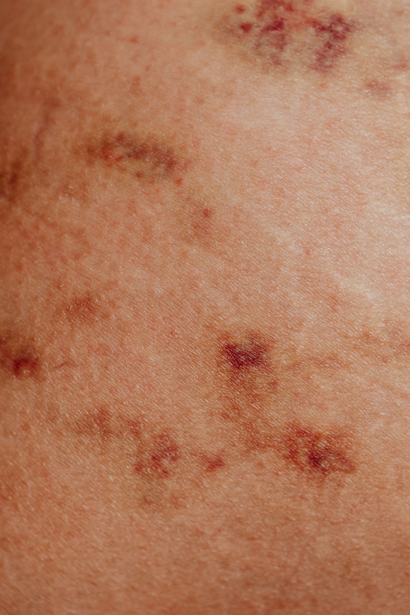 Irritant Dermatitis