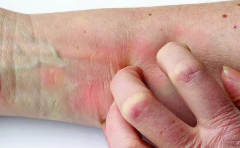 Itchy Skin Itchy Skin