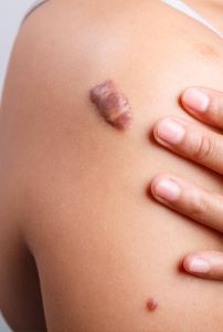 Keloid Scar